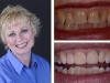 whitening-resin-veneers-01