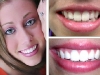 teeth-whitening-01